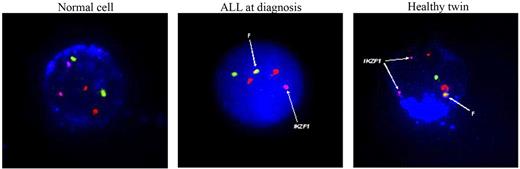 Figure 3. Immunostained for CD19AMCA, leukemic cell nucleus stained with DAPI. Probes used include Vysis BCR/ABL1 ES probe (BCR/chromosome 22 = green, ABL1/chromosome 9 = red) Ikarosbiotin-Cy5 = pink. F = BCR-ABL1 fusion.
