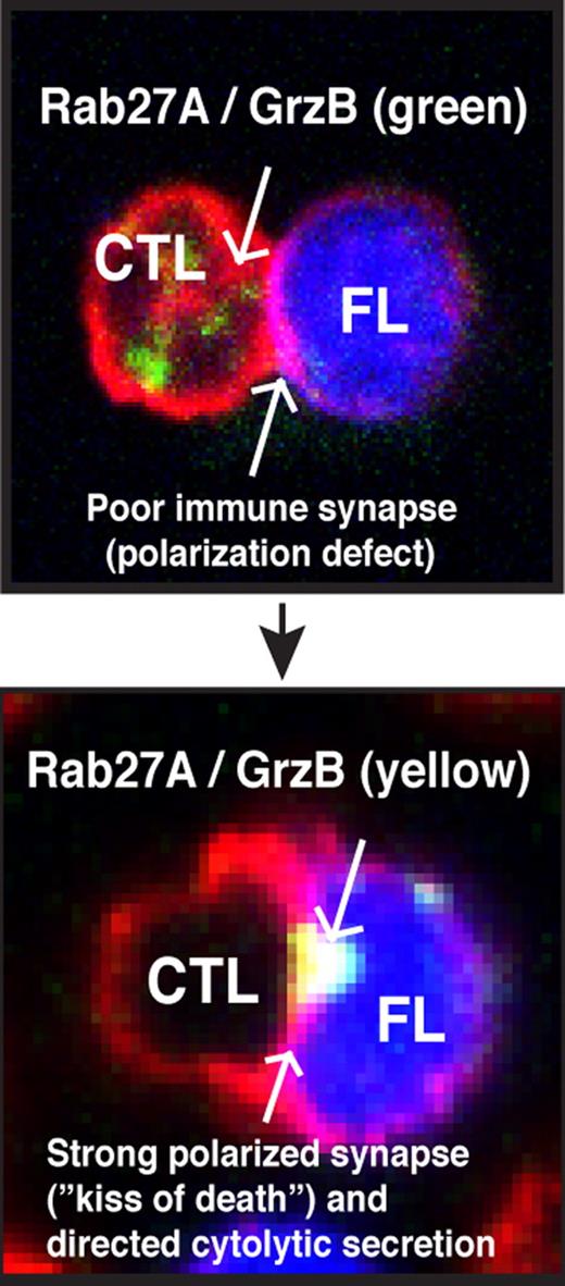 Summary of functional CD8+ T cell (CTL) activity in FL. CTLs have the potential to be powerful effector cells in the treatment of FL. The identification of therapeutic agents or strategies that target and enhance their activity may address the unmet clinical needs in follicular lymphoma (FL). The identification of granzyme B (GrzB) as a powerful biomarker for lytic immune synapse function should aid this translational research goal.