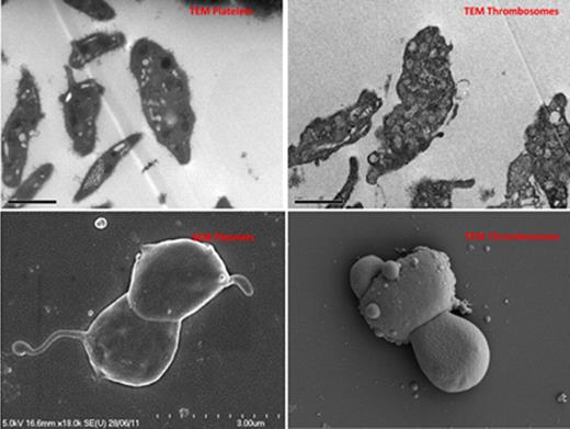 Figure 1:. Scanning electron microscopy - Thrombosomes assumed morphology consistent with activated platelets. On transmission electron microscopy, dense granules and alpha-granules were less distinct than with normal platelets suggesting loss of cytoplasmic architecture and granule integrity.