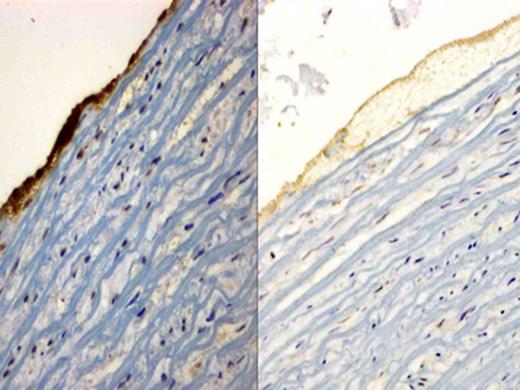 Figure 2:. Immunohistochemical staining of glycoprotein IIb/IIIa receptor, sections were incubated with the mouse anti-human integrin alpha-2b/beta-3 monoclonal antibody and counterstained with hematoxylin. The image on the left is the representative image of thrombus caused by Thrombosomes in PFP. It shows an intense dark stain suggestive of glycoprotein IIb/IIIa receptor expression. The image on the right is PFP and only shows background staining, confirming absence of glycoprotein IIb/IIIa receptor expression.