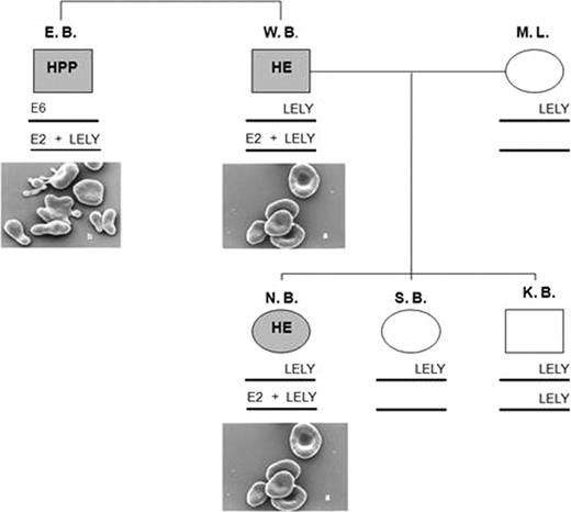 Figure 1. Presence of three mutations in α spectrin within the B. family, leading to Hereditary Elliptocytosis (HE) and Hereditary Pyropoikilocytosis (HPP). It concerns the HE mutations in Exon 2 (59 G/A) and Exon 6 (103 T/C). In addition, the LELY (Low Expression Lyon) mutation is present, which leads to reduced expression/synthesis of α spectrin.