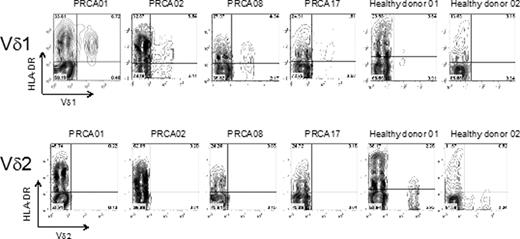 Fig. 1. Expression of HLA-DR on expanded Vd1 T cells in PRCA