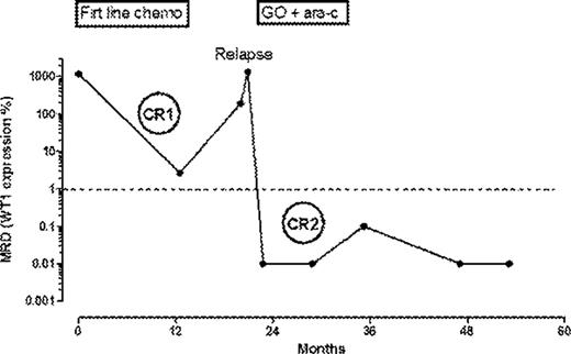 Figure 1. A representative MRD follow-up during CR1, relapse and following by CR2 obtained after fractionated GO + cytarabine (Ara-C)