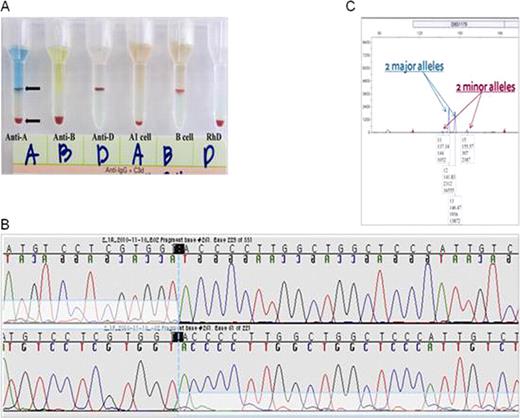 Figure 1. Genotype-phenotype discrepancy due to tri-allelic ABO genotypes. (A) Serologic test using microcolumn agglutination. In the reaction with monoclonal anti-A antibody, double distinct RBC populations are noted. One major (about 70∼80%) population has the O phenotype, while another minor population has the A phenotype. (B) Direct sequencing analysis revealing the heterozygous indel. Small consecutive phase-shifted peaks are seen before and after the site of the deletion (c.261delG) in the reverse and forward reactions, respectively. (C) STR analysis of this patient showing two major and two minor alleles.