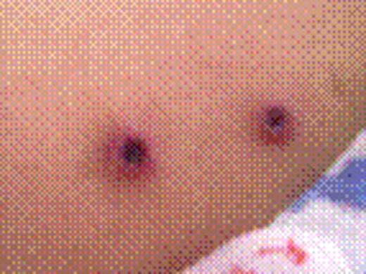 Figure 1:. Skin Eruption