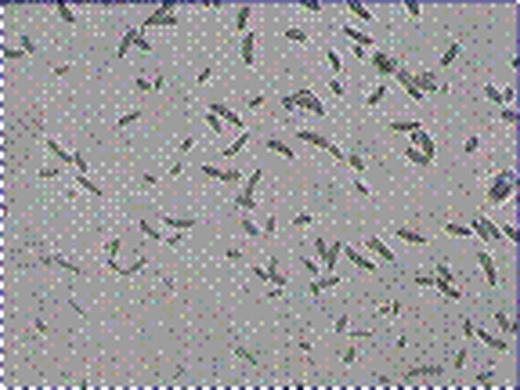 Figure 2:. The Exudatin in erythematous skin bleb culture was positive for Fusarium solani