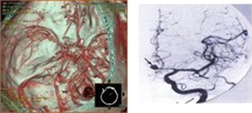 Figure 3:. Magnetic Resonance Imaging(MRI) and CTA revealed rupture of brain aneurysm(Figure 3 A,B).
