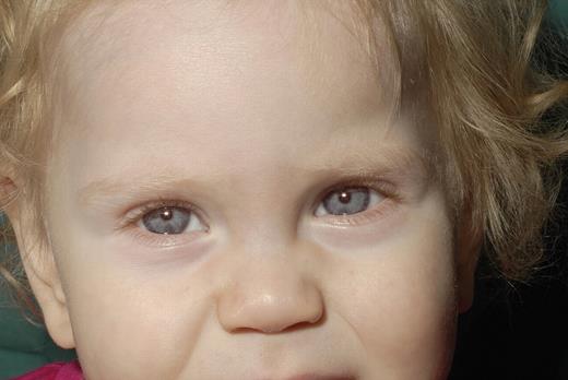 Figure 1. Photographs showing occulocutaneous albinism in proband.