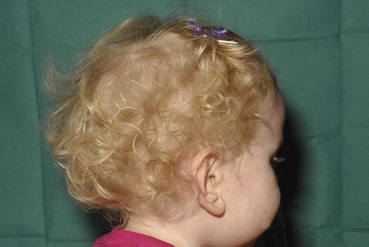 Figure 1. Photographs showing occulocutaneous albinism in proband.