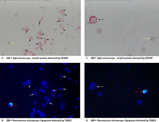 Fig 1. P53 expression and cell apoptosis were simultaneously detected on bone marrow cytospins from del(5q) patients respectively by APAAP and apoptosis. P53 positive cells (red signal indicted by black arrows in panel A and C) did not present apoptosis signal (white arrow in panel B and D), While Apoptosis cell (red arrow in panel B and D) showed p53-negeative signal (yellow arrow in panel A and C).