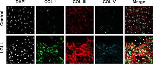 Figure 1. MSCs from Patient Bone Marrow Deposite increase collagen matrix compared to healthy controls.