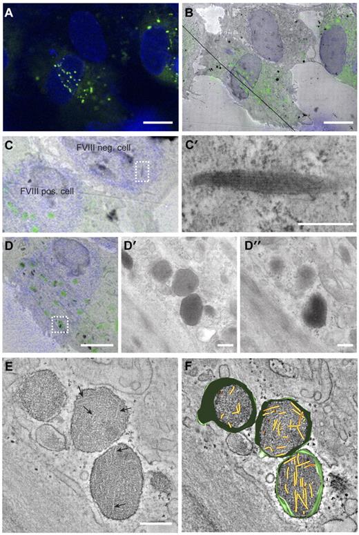 Figure 2. Correlation of FVIII-positive WPBs with rounded, electron-dense structures containing short VWF tubules. (A) Fluorescence image of BOECs expressing FVIII-GFP showing FVIII fluorescence in green and 4,6-diamidino-2-phenylindole staining in blue. Scale bar represents 10 μm. (B) Overlay of transmission electron micrograph and the fluorescence image of the cells shown in panel A. The black line crossing the image represents a fold in the section. Scale bar represents 10 μm. (C) Zoom of panel B showing a FVIII negative and positive BOECs. (C′) Higher magnification TEM view of the boxed area in panel C showing an elongated WPB that does not contain FVIII. Scale bar represents 250 nm. (D) FVIII-positive structures correlating with FVIII-GFP fluorescence. Scale bar represents 4 μm. (D′-D″) Two consecutive sections of the structures boxed in overlay D. Scale bar represents 250 nm. (E) Digital slice through an electron tomogram of the electron-dense structures shown in D-D″ showing FVIII-positive, electron-dense structures with disorganized, short VWF tubules. Arrows indicate longitudinal sections of VWF tubules. Scale bar represents 250 nm. (F) Three-dimensional model of tomogram shown in panel E (see also supplemental Video 1, available on the Blood Web site; see the Supplemental Materials link at the top of the online article). Yellow represents VWF tubules; and green, vesicle membranes.
