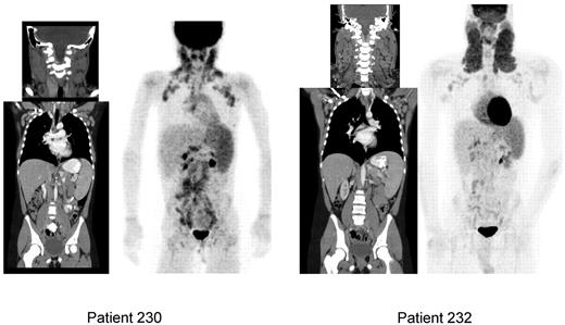Figure 3. CT and FDG-PET scans featuring ALPS-FAS–associated lymphadenopathy and splenomegaly. Patient 230 is a 10-year-old girl, with asymptomatic adenopathy and splenomegaly. Patient 232 is a 22-year-old man, with asymptomatic and visible cervical and axillary lymphadenopathy and modest splenomegaly. No intervention was indicated in both patients. Note the increased uptake in the spleen as a reflection of lymphoproliferation compared with liver in both patients.