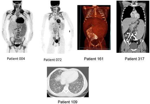 Figure 4. More illustrative examples of FDG-PET and CT scan appearances of some ALPS-FAS patients show splenomegaly and lymphadenopathy. Patient 004 was a 25-year-old man who presented with fever, mouth ulcers, and neutropenia; suspected lymphoma was ruled out after these scans and biopsy of cervical lymph node. The patient underwent splenectomy for persistent cytopenias. Patient 072 was a 12-year-old asymptomatic boy with cervical and axillary adenopathy. Patient 161 was a 9-year-old boy treated with MMF for chronic cytopenias for the last 8 years; 3-dimensional CT reconstruction shows enlarged spleen with volume measured at 1972 cm3. Patient 317 is a 22-year-old man with splenomegaly; CT scan shows a spleen spanning 27 cm. Bottom panel: Chest CT scan appearance in a 19-year-old man (ALPS patient 109) with otherwise asymptomatic nodular lymphocytic pulmonary infiltrates. This patient has also been on therapy for his chronic cytopenias with MMF for the last 7 years.