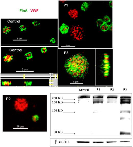 Figure 2. Abnormal presence of FLNa in platelets of 3 patients. Two-color confocal microscopy comparing the distribution of antibodies detecting FLNa (green fluorescence) and VWF (red fluorescence) in fixed and permeabilized platelets. Note that for P1 and P2, the platelets lacking FLNa are the largest, whereas for P3 there is a loss of the more peripheral FLNa organization typical for control platelets. (Right and bottom) Projections of the images on the z-axis showing a cottony appearance. Western blotting with anti-FLNa antibody. Note the signs of FLNa degradation that were more extensive for P3.