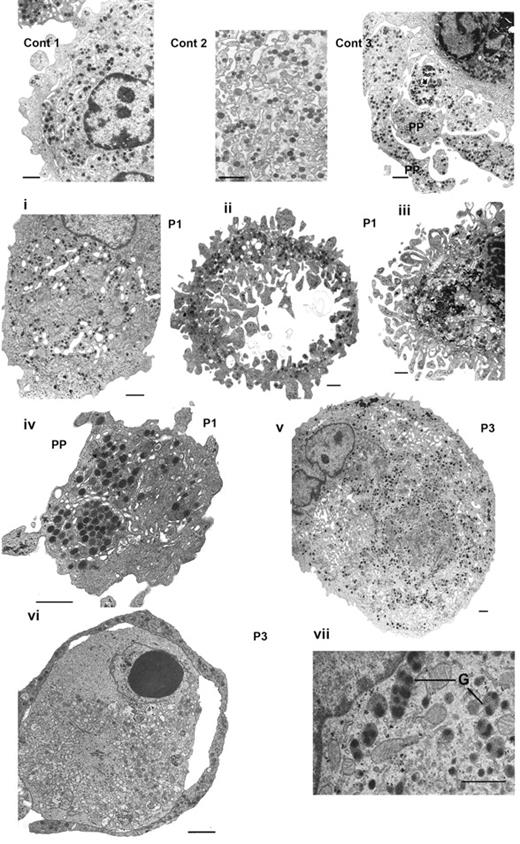 Figure 3. Abnormal MKs observed by EM. Control MKs (Cont) are illustrated in thetop panel: (1) a normal mature MK, (2) DMS and granules shown at higher magnification, and (3) the formation of proplatelets (PP). Next is shown a panel of MKs obtained in vitro culture from CD34+ blood cells from P1 (i-iv) and from P3 (v-vii). Panel i shows heterogeneity in granule and DMS distribution in a large mature MK. Panel ii shows granules are present only in the peripheral ring, whereas the cytoplasm has a disrupted frayed structure with segments of cytoplasm devoid of granules, note also the presence of ghost structures in the center. In panel iii, the nucleus is still present; at the periphery fragments seem to be detaching from the main body of the MK and are often without granules. In panel iv, an abnormal proplatelet has granules concentrated in discrete zones. In panel v, a large MK from P3 has a heterogeneous distribution of granules and abnormal membrane complexes. In panel vi, an abnormal MK with at the periphery a ring-like proplatelet structure containing α-granules; there are signs of apoptosis in part of the cytoplasm and inside the nucleus. Panel vii illustrates immature α-granules (G) with several nucleoids inside of 1 structure. Bars indicate 1 μm.