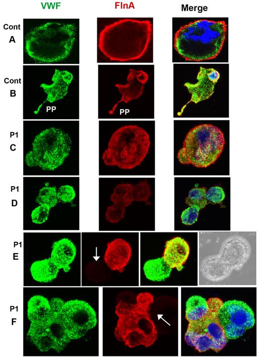 Figure 4. Distribution of FLNa and VWF in mature MKs cultured from CD34+ blood cells of P1. (A-B) Mature MKs from a control donor with the concomitant presence of FLNa and VWF also in the proplatelets. For P1 (C-F), MKs are shown normally containing VWF and FLNa (C), whereas others contain decreased amounts of FLNa (D) or are devoid in FLNa (E-F). Arrows indicate the presence of MKs devoid in FLNa. In panel E, the right side shows the presence of a nucleus, confirming the identification of a cell as an MK by refractory microscopy, in other cells, nuclei are labeled by 4,6-diamidino-2-phenylindole (blue).