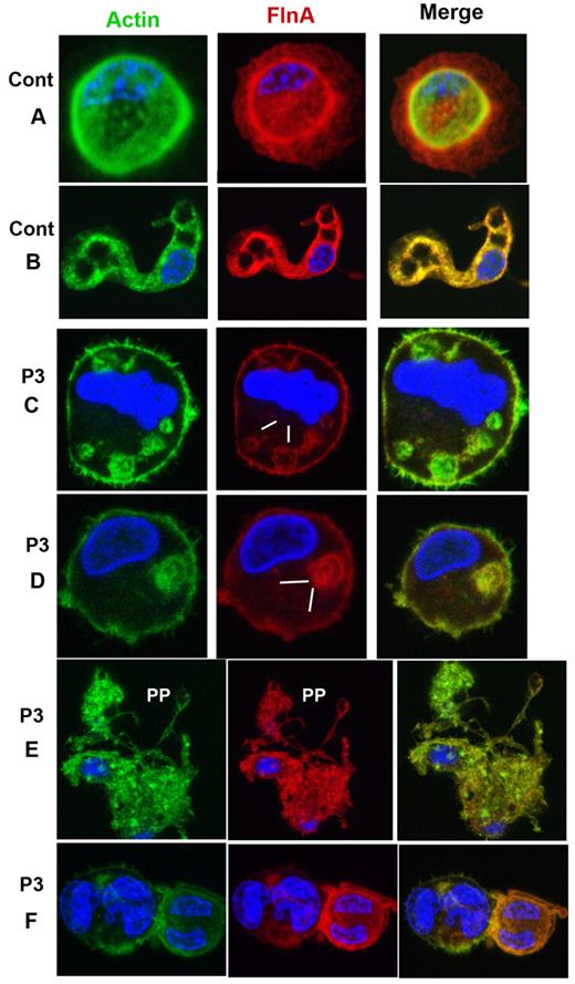 Figure 5. Distribution of FLNa and actin in mature MKs cultured from CD34+ blood cells of P3, with isolated thrombocytopenia. (A-B) Mature MKs of a control donor illustrating the concomitant presence of FLNa and actin also seen in extending proplatelets (B). For P3 (C-F), MKs contain FLNa heterogeneously distributed in patches; interestingly, the same distribution is observed for actin filaments (C-D, zones devoid in FLNa). Panel E shows an MK forming PP; this MK has an irregular distribution of FLNa, the MK seems to be partially disrupted. (F) Small MKs with large nuclei show a colocalization of actin and FLNa.