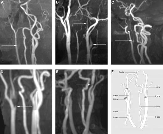 Figure 1. Maximum-intensity projection reconstructions in varying obliquities of 3D time-of-flight MRA of the neck. (A) Patient 1 demonstrates a flame-shaped origin to the ICA (arrow) that is completely occluded without any distal flow. (B) Patient 6 demonstrates a flame-shaped narrowing (arrow) to the origin of the right ICA that is of a much-reduced caliber (string sign) distally (arrow). (C) Patient 7 demonstrates a much-reduced caliber ICA (arrow) from its origin, the so-called “string” sign. (D) Patient 9 demonstrates a focal stenosis at the origin of the ICA (arrow) with reduced caliber distal to the stenosis. (E) Patient 10 demonstrates a short focal stenosis (arrow) well above the origin of the ICA that is otherwise of normal caliber. (F) Line drawing of unrotated cMRA illustrating the normal anatomy of arterial vessels in the neck and indicating the sites of stenosis and occlusion in patients 1-10 (shaded). eca indicates external carotid artery; cca, common carotid artery; and vert, vertebral artery.