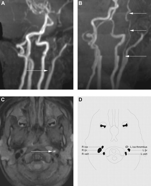Figure 2. Imaging of patient 4. (A) Maximum-intensity projection of a 3D time-of-flight MRA of the neck vessels in an oblique projection. Flow is just visible at the origin of the left ICA (arrow), but distal flow is attenuated and discontinuous. (B) Maximum-intensity projection of the repeat 3D time-of-flight MRA of the neck vessels at 3 months. The left ICA now shows continuous flow, but remains of diffusely reduced caliber (arrows). The linear artifact across all the vessels is due to the multi-slab MR technique. (C) Axial T1-weighted image with fat saturation showing high signal thrombus in the lumen of the left ICA (arrow), whereas no hematoma is seen in the wall of the vessel. (D) Line drawing illustrating anatomical features of panel C. ijv indicates internal jugular vein; and vert, vertebral artery.