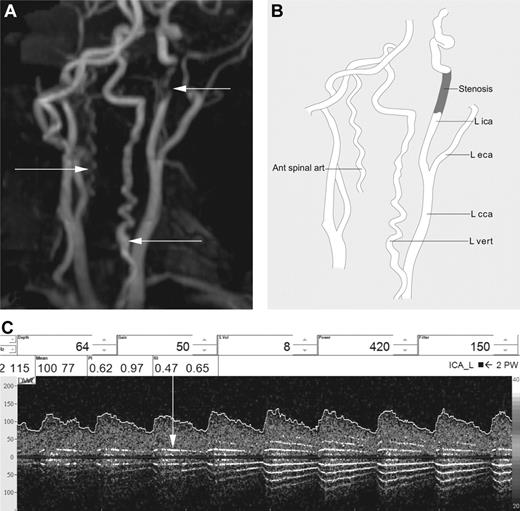 Figure 3. Imaging of patient 5. (A) Severe stenosis in the distal cICA can be seen, along with tortuosity of the vertebral arteries and a prominent, tortuous anterior spinal artery. (B) Line drawing illustrating anatomical features. (C) Audible turbulence in terminal ICA on TCD sonogram (vertical arrow).