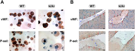 Figure 2. Immunohistochemistry analysis demonstrates the tissue-specific deficiency of P-selectin in megakaryocytes of FOG1 ki/ki mice. (A) Representative images of cytospun FL-derived megakaryocytes from FOG1 ki/ki and littermate WT mice stained for VWF (top row) or P-selectin (bottom row) using immunohistochemistry. Note the similar levels of VWF but significant deficiency of P-selectin in the FOG1 ki/ki megakaryocytes. Bar represents 40 μm. (B) Representative images of liver sections showing hepatic veins with intraluminal clots and labeled by immunohistochemistry for VWF (top row) or P-selectin (bottom row). Note that VWF (top row) was expressed at comparable levels in the endothelial lining (red arrows) and platelets (blue arrowheads) from WT and FOG1 ki/ki mice. Whereas P-selectin (bottom row) was expressed at comparable levels in the endothelial lining of WT and FOG1 ki/ki (red arrows), P-selectin was not detected in the platelets from FOG1 ki/ki mice (blue arrowheads). Bar represents 40 μm.