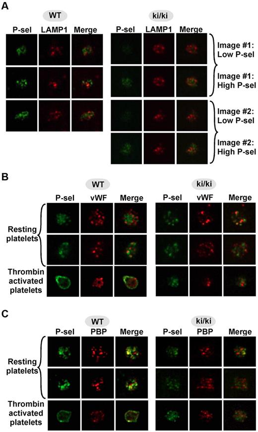 Figure 4. Deconvolution immunofluorescence microscopy analysis of platelets isolated from WT and FOG1 ki/ki mice. (A) Paraformaldhyde-fixed and permeabilized WT and FOG1 ki/ki platelets were labeled with antibodies to P-selection (P-sel; green) and to the lysosomal marker LAMP1 (red). For WT platelets, 3 separate studies are shown on left. Because of the weak P-selectin expression in FOG1 ki/ki platelets relative to WT cells when the images were taken at the same exposure and gain settings as in WT (top row for images 1 and 2 on left), the same P-selectin image was taken at a higher setting to provide a more comparable signal to WT (bottom row for images 1 and 2 on left). There was no obvious variation in LAMP1 levels. Longer exposure of the P-selectin label in FOG1 ki/ki platelets (bottom rows) reveals vesicular labeling that does not overlap with that for LAMP1. (B-C) Resting (top 2 rows) or thrombin-activated (10 minutes; bottom row) platelets were labeled for (B) P-selectin (green) and VWF (red) or (C) P-selectin (green) and PBP (red). P-selectin exposure was again increased for the FOG1 ki/ki and labeling partially overlaps labeling for both VWF and PBP in resting platelets from both WT and FOG1 ki/ki platelets. After thrombin treatment, P-selectin is mobilized to the cell surface in WT but not FOG1 ki/ki platelets. Note that levels of VWF and PBP expression are not substantially different in resting WT and FOG1 ki/ki platelets and do not substantially change on thrombin stimulation of FOG1 ki/ki platelets.