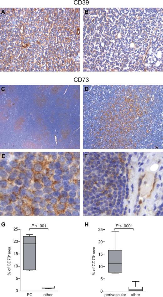 Figure 1. Immunohistochemistry analysis of CD39 and CD73 expression. (A-B) Anti-CD39 immunostaining of 2 representative LN tissue sections using anti-mouse HRP-conjugated secondary Ab and 3,3′-diaminobenzidine (brown signal). CLL lymphocytes stain uniformly positive, even if with different intensity levels. Original magnification ×20. (C-D) Anti-CD73 immunostaining of a representative LN from a CLL patient using anti–rabbit HRP-conjugated secondary Ab and 3,3′-diaminobenzidine (brown signal). Low magnification shows CD73 expression around the paler areas corresponding to the proliferation centers. Original magnification ×4 (C) and ×10 (D). (E-F) Higher magnification shows that CD73+ cells have a prolymphocytic morphology and that perivascular areas are enriched in CD73+ cells. Endothelial cells are CD73+, as expected. Original magnification ×40. (G-H) Quantification of the percentage of CD73+ areas (brown pixels) in at least 15 different ×20 fields obtained from 5 independent sections depicting proliferation centers (PC), vessels, or the rest of the section (other). Images were analyzed using a DMI 3000 B optical microscope (Leica Microsystems), equipped with a DCF 310 FX digital camera and LAS Version 3.8 software.