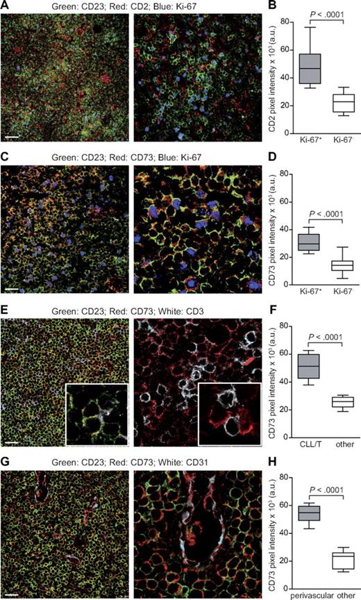 Figure 2. CD73 is expressed by proliferating CLL cells and is enriched in perivascular areas. (A) Triple staining of a representative CLL LN section with anti-CD23 (green), anti-CD2 (red), and anti–Ki-67 (blue). CLL proliferation centers are defined as areas enriched in Ki-67+ (blue) CD23+ (green) CLL cells and in CD2+ T lymphocytes (red). Original magnification ×20 for image on the left and ×63 for that on the right. Scale bar represents 75 μm. (B) Cumulative analysis of CD2 pixel intensity (arbitrary units, a.u.) indicates that expression is significantly higher in Ki-67+ than in Ki-67− areas. (C) Triple staining for CD23 (green), CD73 (red), and Ki-67 (blue). Original magnification ×63; zoom factor of 3 for image on the right. Scale bar represents 25 μm. (D) Cumulative data of CD73 pixel intensity (a.u.) from Ki-67+ and Ki-67− areas. (E) Triple staining (left) for CD23 (green), CD73 (red), and CD3 (white) and double staining (right) for CD73 (red) and CD3 (white). Original magnification ×63; zoom factor of 3 for image on the right. Scale bar represents 25 μm. (F) Comparative analysis of CD73 pixel intensity (a.u.) in T cell–rich vs T cell–poor areas from different LN sections. (G) Triple staining for CD23 (green), CD73 (red), and CD31 (white). Original magnification ×63; zoom factor of 3 for image on the right. Scale bar represents 25 μm. (H) Cumulative analysis of CD73 pixel intensity confirms significantly higher intensity in perivascular versus nonperivascular areas. For cumulative analysis, 4 randomly chosen fields from 4 different samples were counted. All samples were analyzed using a TCS SP5 laser scanning confocal microscope (Leica Microsystems) with a 20×/0.5 and an oil immersion 63×/1.4 objective lenses, images were acquired with LAS AF Version Lite 2.4 software and processed with Photoshop (Adobe Systems). Pixel intensities were calculated with ImageJ software (freely downloadable at http://rsbweb.nih.gov/ij/), and statistical analysis was performed using Student t test.