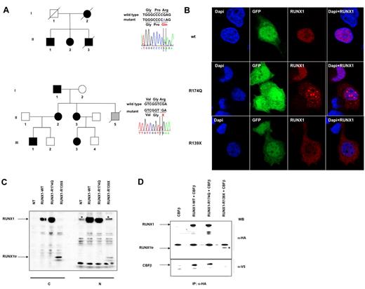 Figure 1. Two germline mutations in the RUNX1 gene in a familial thrombocytopenia with a propensity to develop acute myeloid leukemia (FPD/AML). (A) Left panels: pedigree A (top) harbors the R174Q; pedigree B (bottom), the R139X mutations. Circles indicate females; squares, males; black filled symbols, affected individuals; gray filled symbol, individual with non hematologic disease; white symbols, nonaffected individuals; and symbols with a diagonal line, deceased individuals. Right panels: analysis of RUNX1 (NM_001001890.2) exon 5 (top panel) showing the heterozygous germline R174Q mutation and exon 4 (bottom panel) showing the heterozygous R139X mutation. (B) Localization of RUNX1 in HEK293T cells after transfection with the lentiviruses encoding for wtRUNX1, or R174Q RUNX1 or R139X RUNX1 and GFP. Immunofluorescence staining of RUNX1 was performed using an anti-HA Ab (red); the nucleus is stained with DAPI (blue). wtRUNX1 protein is localized exclusively in the nucleus with a diffuse pattern. R139X RUNX1 protein is mainly diffused in cytoplasm. R174Q RUNX1 protein is mainly localized in nucleus. In 65% of cells it is localized in dense foci and in 35% of cells, a diffuse pattern is observed. (C) Western blot (WB) analysis of RUNX1, expression in cytoplasmic (C) and nuclear (N) extracts from HEK293T cells overexpressing wild-type (wt), mutant R174Q or mutant R139X RUNX1 (RUNX1tr). RUNX1 forms were tagged with a HA epitope. Western blots (WB) were performed using anti-HA Ab. RUNX1tr: R139X RUNX1 truncated protein. *The nonspecific bands appearing using the anti-HA Ab in nuclear extracts. (D) Interactions between CBFβ and wt or mutant RUNX1 proteins in nuclear extracts from HEK293T cells transfected with CBFβ alone (lane 1) or together with wt RUNX1 (lane 2) or R174Q RUNX1 (lane 3) or R139X RUNX1 (lane 4). CBFβ was tagged with the V5 epitope and RUNX1 forms with a HA epitope. Immunoprecipitation (IP) was performed using an anti-HA Ab and Western blots (WB) using anti-HA and anti-V5 Abs. *Presence of RUNX1tr which is R139X RUNX1 truncated protein.