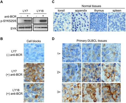 Figure 2. SYK is activated in primary DLBCL tissues. (A) Immunoblotting of total and phosphorylated SYK (pY525/526) in LY7 and LY18 cell lines. Cells were stimulated with (+) or without (-) anti-BCR as described in “Methods.” (B) Immunohistochemical staining of p-SYK (pY525/526) on sections of paraffin cell blocks made from anti-BCR stimulated (+) or unstimulated (-) LY7 and LY18 cells. Photomicrographs were generated using Nikon E600, Planachromat 4/0.10/30.0, 20/0.40/1.3, PlanApo 40/0.095/0.12-0.16, and PlanFluor 40/0.75/0.72 objectives, and were captured using an Olympus DP12 camera. (C-D) Immunohistochemical staining of p-SYK on paraffin-embedded sections from tissue microarray in normal lymphoid tissues (C) and DLBCL tissues (D). The ranges for the scoring system are shown.