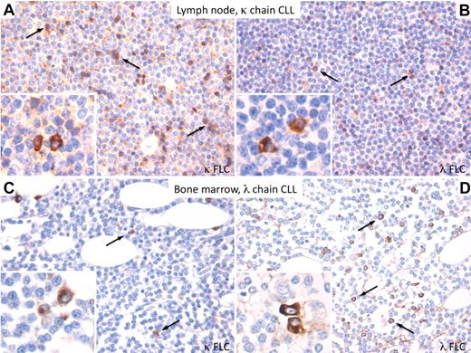 Figure 5. In situ immunohistochemical detection of free κ and λ chains in the CLL microenvironment. (A-B) In lymph node infiltrates of a κ-chain CLL case, a prominent population of plasmacytoid lymphocytes expressing the κ FLC is detected along with a lower number of lymphocytes showing expression of the clone-unrelated λ chain, both populating the same microenvironment. Scattered plasma cells with either κ or λ FLC expression are also detected (panels A and B insets). (C-D) A similar picture is observed in bone marrow lymphoid infiltrates of a λ-chain CLL case. Immunohistochemistry performed by the streptavidin–avidin-biotin complex using the 3-3′-diaminobenzidine chromogen (brown signal). Original magnifications ×200 for all panels and ×400 for insets.