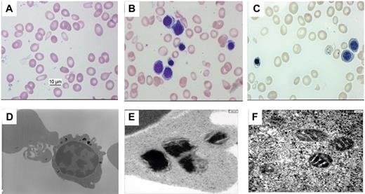 Figure 1. Morphologic analysis of blood and bone marrow smears. (A) Morphology of red blood cells of the Propositus in peripheral blood smears shows distinct aniso-poikilocytosis, microcytosis, and hypochromasia. (B) Morphology of erythroblasts in bone marrow smears shows poor hemoglobinization with a ragged appearance of the cytoplasm (panoptic stain). (C) Perls' staining of bone marrow smears shows 2 basophilic erythroblasts without and 1 mature erythroblast with abnormally large siderotic granules, some of them clustered around the nucleus. One mature erythrocyte also displays multiple blue granules. (D) Transition electron micrograph of a polychromatophilic erythroblast (× 8000) showing many large siderotic granules. Top left: siderocyte. (E) Transition electron micrograph of an erythroblast (× 25 000) showing amorphous electron-dense material within structures suggestive of a lysosome or degenerative mitochondria. (F) Transition electron micrograph of an erythroblast (× 25 000) showing iron loaded mitochondria with retained cristae.