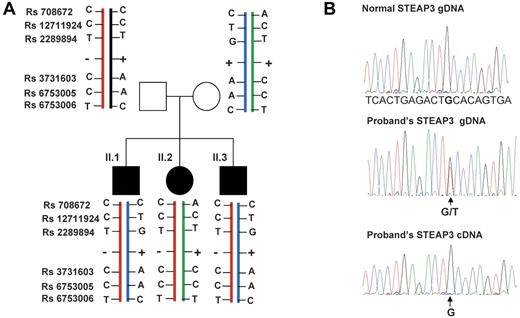 Figure 2. Pedigree of the family and transmission of the STEAP3/TSAP6 alleles. (A) The nonsense mutation p.C100X (−) was found in the heterozygous state in the 3 affected siblings and in their healthy father. + symbolizes the normal allele. Genotyping results of several common polymorphisms indicated that the mother transmitted the same STEAP3/TSAP6 haplotype to both her sons and the other haplotype to her daughter. Rs708672 and Rs12711924 are located in the promoter region and upstream of the gene, Rs2289894 is located in the first intron, Rs3731603, Rs6753005 and Rs3753006 are located in the 3′untranslated region. (B) Representative electrophoregrams of the normal and proband's genomic (gDNA) sequences, and the patients' cDNA sequence (sequence of the negative strand is shown). The arrow indicates the position of the heterozygous nucleotide substitution. The proband's cDNA sequence shows that only the normal allele is present at the cDNA level. The same results were obtained for the 3 affected sibling and for their father.