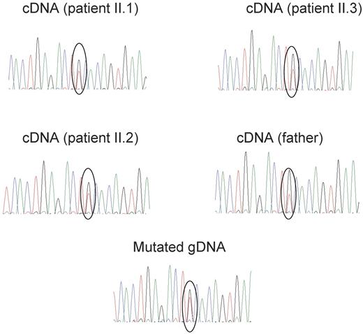 Figure 4. Expression of normal and mutated STEAP3/TSAP6 alleles in lymphocytic cell lines from the father and the 3 affected children. Lymphocytic cell lines were cultured in the presence of emetin for 24 hours before being harvested, to prevent nonsense-mediated mRNA decay of the mutated mRNA. Electrophoregrams show that the ratio of the C (normal) to the A (mutated) allele is higher in the unaffected father than in his 3 affected offspring. Quantification of this expression ratio normalized for the C to A ratio in the mutated genomic DNA was performed using the “peak picker” software. Sequencing replicates from 3 independent RT-PCR were used to calculate the allelic ratios. The allelic ratios were 1.72 ± 0.05 in the father and 1.19 ± 0.03, 1.14 ± 0.027, 1.27 ± 0.032 in the affected children (mean ± SD). The difference between the father and each of his children was highly significant (P < .001, Student t test).