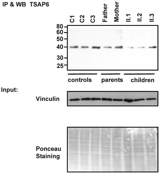 Figure 6. STEAP3/TSAP6 protein expression in B-lymphocytic cell lines. Immunoprecipitation followed by Western blot analysis of the STEAP3/TSAP6 protein using anti-mSTEAP3/TSAP6 antibodies. STEAP3/TSAP6 is expressed in both parents but clearly decreased in the derived lymphocytic cell lines of the II.1 and II.2 siblings. Vinculin expression and Ponceau staining are shown for equal loading.