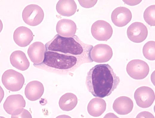 A 45-year-old woman had asthenia, diffuse myalgias, and mild splenomegaly. Her history included smoking and no evidence of viral illness. There was no family history of lymphoid disorders. Laboratory tests showed lymphocytosis (6.1 × 109/L) that had been present for years without anemia and thrombocytopenia. Peripheral blood smears usually show ∼ 10% of the lymphocytes as binucleated (see figure). A polyclonal increase of serum IgM (10.1 g/L) has been present. Immunophenotyping demonstrated a polyclonal population of B lymphocytes (IgM+, IgD+, CD19, CD20, CD27, and FMC7 positivity and CD5, CD10, CD23, and CD43 negativity). Karyotype and FISH revealed an isochromosome for the long arm of chromosome 3, +i(3q), and an acquisition of +3 and +18. Tests for viral infection, hormone abnormalities, and connective tissue diseases have been negative. A diagnosis of persistent polyclonal B-cell lymphocytosis (PPBL) was made and her case has remained stable for 12 years. Although lymphocytosis has increased (11.9 × 109/L), there has been no evidence of malignant lymphoma transformation. / PPBL is an infrequent disorder, characterized by chronic lymphocytosis, binucleated lymphocytes, polyclonal increases in IgM, and cytogenetic abnormalities of chromosome 3. Many of the patients are middle-aged women who smoke. This polyclonal disorder rarely converts to malignant lymphoma.