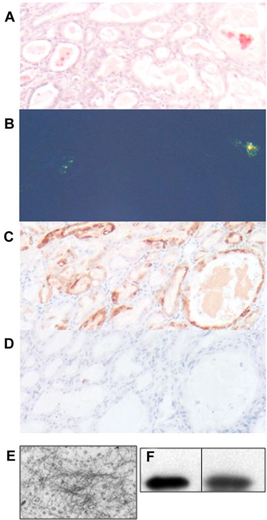 Figure 3. Amyloid deposits in the stomach of CMV-λ6 transgenic mice. Stomach sections were stained with Congo red and counterstained with hematoxylin visualized by brightfield (A) or polarized light microscopy (B). (C-D) Demonstration of immunohistochemical staining with anti–human λ and anti–human κ LC, respectively. (E) Negative staining EM of the contents of the stomach glands in the stomach of a transgenic mouse with Congo red positive deposits. Fibril diameters are approximately 10 nm. (F) Immunoblot for human λ LC in protein extracted from stomach amyloid deposits isolated by LCM (lane 1); serum from a transgenic mouse as a control (lane 2). The vertical line indicates that noncontiguous lanes from the same immunoblot image are displayed.