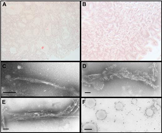 Figure 6. Doxycycline prevents amyloid deposition in vivo and directly interacts with LC in vitro. (A) In control CMV-λ6 transgenic mice drinking water alone, 69% (11/16) had Congo red positive deposits in the stomach. (B) Deposits were inhibited by oral administration of doxycycline in the drinking water, identified in only 23% (4/17) of the treated mice (P = .00006, χ2 analysis). (C) For a 5-day period of incubation, recombinant amyloidogenic LC in vitro form typical amyloid fibrils, as visualized by negative stain TEM, (D) whereas incubation with 250 mg/L doxycycline resulted in degraded and broken fibrils and disorganized bundles of immature fibrils (data not shown). (E) With 15 mg/L doxycycline, broken fibrils with frayed ends were observed. (F) Amyloid fibrils extracted from autopsy material formed numerous large aggregates after incubation with doxycycline. (C-E) Magnification ×42 000, bar = 100 nm; magnification ×10 000, bar = 500 nm.