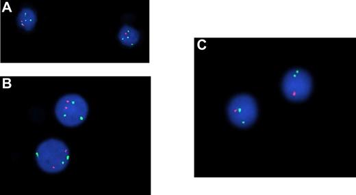 Figure 3. Genomic aberrations are frequently detected by FISH in CLL-like MBL clones. FISH analysis has been performed on CD5+CD20dim purified MBL cells and shows, (A) on the left, a normal nucleus with 2 signals for each probe (Spectrum Aqua, Orange, and Green) corresponding to LSI13q34 locus 13q34, LSI D13S319 locus 13q14.3, and CEP 12 locus 12p11.1-q11, respectively; on the right another nucleus with a heterozygous deletion of the LSI D13S319 locus 13q14.3 (1 Spectrum Orange signal and 2 normal Spectrum Aqua and 2 Spectrum Green signals). (B) Both nuclei show trisomy of CEP 12 locus 12p11.1-q11 (3 Spectrum Green signals) and 2 normal Spectrum Orange signals (LSI D13S319 locus 13q14.3). (C) Both nuclei show the presence of only one signal for LSI p53 locus 17p13.1 (Spectrum Orange) and a normal double signal for LSI ATM locus 11q22.3 (Spectrum Green). Microscope used for these images was Nikon Eclipse 90i with a magnification ×1000 (Objective PLAN APO VC 100X/1:40 oil; 10× ocular; room temperature), and camera used was Qicam Fast 1394 (Qimaging). The imaging medium used was DAPI (Vectashield Mounting Medium with DAPI, vector). Acquisition software was Genikon (Nikon Instruments S.P.A.) and a FISH 3D Acquisition Module was used.