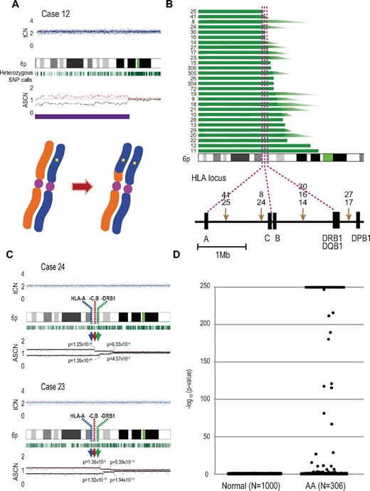 Figure 2. Acquired 6pLOHs in AA patients that target the HLA locus. (A) Typical CNAG outputs in SNP array analysis showing CNN-LOH (purple line) that appears as significant dissociation in allele-specific copy number graphs (red and green lines) from the baseline with normal total copy numbers (tCN; top panel). As a result of an allelic conversion, the affected segment causes LOH (* indicates 1; bottom panel). The “acquired” origin of these lesions is indicated by the retention of substantial numbers of heterozygous SNP calls (green bars below the chromatogram) that would otherwise mostly disappear. (B) The breakpoints of 6pLOHs found in a total of 28 AA cases, all involving the HLA locus in common. In more than half of cases (indicated by arrowheads in panel B), the exact location of the breakpoint was difficult to uniquely determine, where dissociation of the allele-specific copy number graphs continuously tapered along the 6p arm, indicating the presence of multiple 6pLOH(+) clones with common missing alleles (C). Indeed, the breakpoint containing regions are separated into multiple segments having significantly different copy numbers in the circular binary segmentation model, as indicated by solid lines with P values. Note that the most telomeric breakpoint is located within (case 24) or centromeric to (case 23) the HLA locus in each case. (D) A skewed distribution of the logarithm of P values in AA cases compared with normal persons. The P values were calculated in the Mann-Whitney U test, with which the difference in the mean allele-specific copy numbers between 6p and other chromosomal regions was evaluated (see “Analysis of genomic copy numbers and detection of 6pLOH”). A total of > 250 values are plotted as 250.