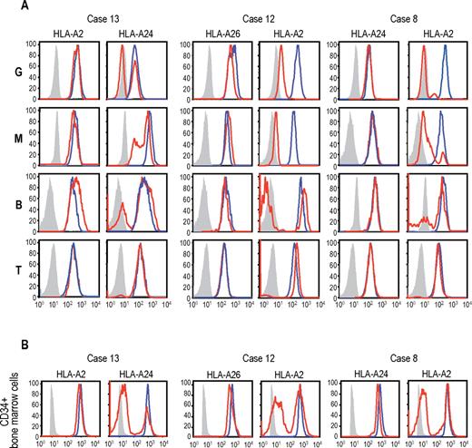 Figure 3. Uniparental expression of HLA in AA cases with CNN-LOH in 6p. Allele-specific expression of HLA-A antigens in AA specimens was examined by flow cytometry using monoclonal antibodies that specifically recognize the indicated HLA types (red lines), where leukocytes from healthy persons were used as a control (blue lines). (A-B) The uniparental expression of HLA-A antigens in PB leukocytes and BM CD34+ cells obtained from 3 AA cases with CNN-LOH in 6p. Different leukocyte compartments were separately examined, including granulocytes (G), monocytes (M), B-lymphocytes (B), and T-lymphocytes (T).