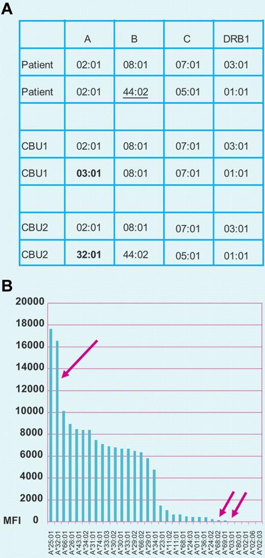 (A) HLA alleles of patient receiving a double cord blood transplantation and of the 2 CBU infused. Patient and CBU1 present 2 mismatches in HLA-A and HLA-B loci; the mismatches at these loci occur in the HvG (HLA-A*03:01) and GvH (B*44:02) vectors, respectively, because the patient and donor are homozygous at these loci. CBU2 and the patient present only one mismatch (only in the HvG vector; A*32:01). These units present single mismatches in HLA-A in the HvG vector (A*03:01 in CBU1 and A*32:01 CBU2). (B) Evaluation of anti-HLA antibodies in the patient's serum. The patient's serum shows strong reactivity against the antigen preparation of A*32:01 present in CBU 2 and shows negligible reactivity against A*03:01 present in CBU1 and the patient's self–HLA-A antigen A*02:01. These test results indicate that CBU2 is at high risk of rejection and CBU1 is likely to engraft. Professional illustration by Paulette Dennis.
