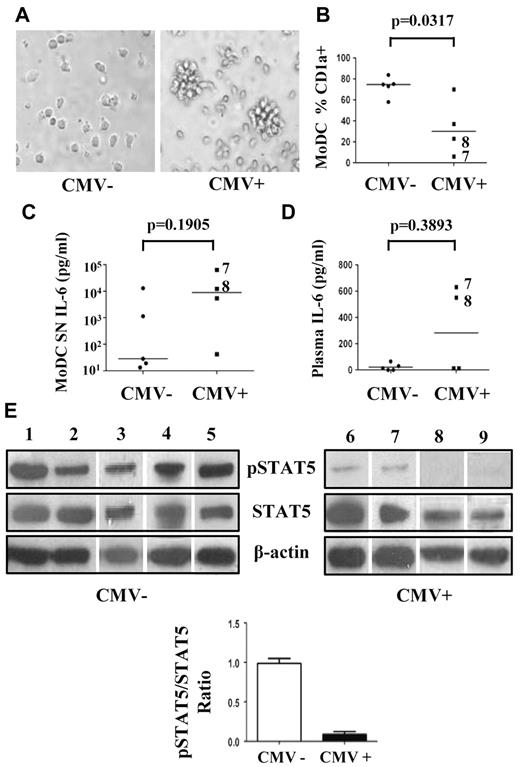 Figure 7. Reduced CD1a and pSTAT5 in MoDCs from viremic patients who had received a transplant. Monocytes were isolated from the blood of patients who had received a transplant with the use of Ficoll gradients followed by sorting with anti-CD14 magnetic separation beads. Cells were differentiated into MoDCs in culture medium containing GM-CSF and IL-13 for 5 days. (A) Light microscopy of monocytes after 3 days in culture (×200; Zeiss, Telaval 31). Images were acquired with a Nikon Eclipse TE 2000_v; 20×/0.35 objective; culture medium 37°C; camera: Nikon DX71200C; Adobe Photo-shop 9.02. (B) The percentage of MoDCs expressing CD1a was determined by flow cytometry. (C-D) Amounts of IL-6 secreted by MoDCs (C) and in plasma of patients who received a transplant (D) were determined by CBA. (E) Total and phosphorylated STAT5 (pSTAT5) was assessed by Western blotting of MoDC extracts with β-actin as control. The histogram below the Western blots represents quantification of proteins from all the patients. Lines represent median values. Mann-Whitney U tests were used to determine statistical significance.