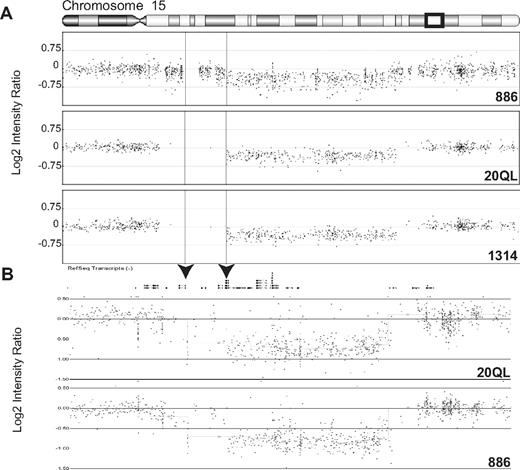 Figure 2. Deletions involving RPS17 in DBA probands. (A) Log2 intensity ratio of SNP probes in the deletions adjacent to RPS17 on chromosome 15. The locations of 2 identical copies of RPS17 are indicated by the vertical lines. The identified region of copy loss is adjacent to RPS17; however, the paucity of probes, notably in the HumanOmniExpress chip (20QL and 1314), is apparent. (B) Log2 intensity ratios of CGH probes in the region of RPS17. Arrows at the top of the panel indicate the positions of RPS17. Gray points and connecting line depict a 30-kb median smoothing window. The region displayed is chromosome 15 from 79 450 000-83 800 000.