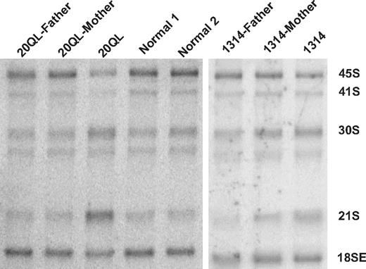 Figure 4. Small subunit rRNA processing abnormalities in patients with RPS17 deletions. Northern blot analysis of rRNA with a hybridization probe to 18SE/ITS1 (probe γ)25 shows increased steady-state levels of 21S rRNA, indicating a functional ribosomal abnormality in patients with RPS17 deletions.