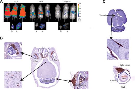 Figure 4. SD1 cells produce CNS disease in a mouse model. (A) Representative images of 3 mice from a cohort of 10 animals/cell line are shown. SD1, REH, and SupB15 cause disease in SCID-Beige mice, with SD1 producing the highest disease burden as measured by bioluminescence. The lower panel shows the representative luminescence activity in brain (b) and skull (s) for each cell line. Bioluminescence values are indicated as photons/cm2/s. (B) Histological sections of the brain of a representative SD1-engrafted SCID-Beige mouse. Sections were stained with anti-GFP antibody and show infiltration in the nasal region and cranial marrow cavity. Cells can be seen within blood vessels (bv) of the brain parenchyma and within the choroid layer of the eye. (C) Section through the brain of a representative mouse transplanted with SD1 cells showing cells within the lateral ventricles (top and middle panels) and infiltrating along the optic nerve (bottom panel). Images were captured on a Mirax scanner (3Dhistech) using a Zeiss Fluor 20×/0.75 NA objective lens and a Marlin (Allied Vision Technologies) color camera. The system uses the 3DHistech scan software, and images were viewed and exported using 3DHistech panoramic viewer software.