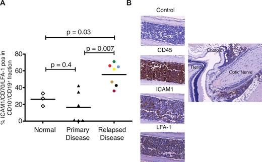 Figure 6. Subsets of CD10+/CD19+ lymphoblasts express ICAM1, LFA-1, and cause CNS disease in mice. (A) The CD10+/CD19+ cell population of patients with relapsed ALL significantly overexpress LFA-1/ICAM1/CD70 compared with the CD10+/CD19+ cell populations of normal volunteers (controls) and those with de novo disease. Horizontal lines denote mean values. (B) Histopathological sections obtained from a representative mouse transplanted with cells from patient 36 (purple circle in panel A). The left panel shows infiltration of cranial bone marrow by ICAM1- and LFA-1–positive leukemic cells. The right panel shows infiltration of CD45-positive cells along the optic nerve. Images were captured on a Mirax scanner (3Dhistech) using a Zeiss Fluor 20×/0.75 NA objective lens and a Marlin (Allied Vision Technologies) color camera. The system uses the 3DHistech scan software, and images were viewed and exported using 3DHistech panoramic viewer software.