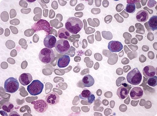 A 59-year-old woman with malaise was admitted to hospital with hemoglobin at 9.2 g/dL. Platelets were normal, leukocytes were 3.2 × 103/μL, reticulocytes were low, and mean corpuscular volume was 128 fL. The peripheral smear showed hypersegmentation and large polychromatophilic erythrocytes. A vitamin B12/folate deficiency was suspected. However, initial laboratory work showed vitamin B12 at 490 pg/mL (normal, 176-949 pg/mL) and folate at 10.3 ng/mL (normal, 2.6-16.0 ng/mL). Bone marrow showed megaloblastic erythroblasts, megaloblastic metamyelocytes with large bone-shaped nuclei, and mature neutrophils with hypersegmentation. Homocysteine and methylmalonic acid were elevated (65.7μM and 4846 nmol/L, respectively), indicative of a functional vitamin B12 deficiency. In addition, holotranscobalamin, the biologic available form of vitamin B12, was < 1 pmol/L. Antibodies against intrinsic factor were strongly positive. / A diagnosis of vitamin B12 deficiency was still suspected despite the initial vitamin B12 level. An assay from another manufacturer showed the vitamin B12 low at 79 pg/mL (196-863 pg/mL). As a result, a pharmacologic dose of vitamin B12 (1000 mg IM) was given and resulted in a complete clinical and hematologic response. / When a clinical picture, peripheral blood smear, and marrow suggest vitamin B12 or folate deficiency, an initial normal laboratory value may require repeat testing. An assay from another manufacturer affirmed the diagnosis in this case and pointed out an erroneous result by the original test kit.
