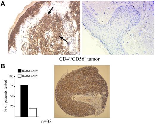 Figure 4. BAD-LAMP is a marker of blastic pDC neoplasms. (A) Immunohistochemistry on paraffin sections of skin lesions from patients with BPDCNs reveal a massive infiltration of BAD-LAMP+ cells (arrows, ×400). Negative staining with mouse IgG isotype control is shown on the right. (B) A larger-scale analysis by tissue arrays revealed that > 78% of biopsies were BAD-LAMP+ among 33 patients diagnosed with a CD4+/CD56+ malignancy (left). An example of a BAD-LAMP+ biopsy from the tissue array is also shown (right).